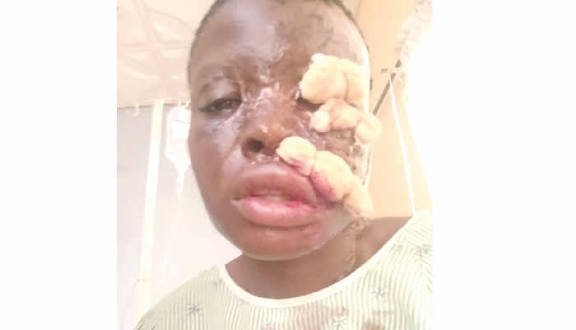 Man suffers from acid A young man screaming in pain after being attacked with acid by his girlfriend during a breakup fight in Port Harcourt, surrounded by shocked bystanders.